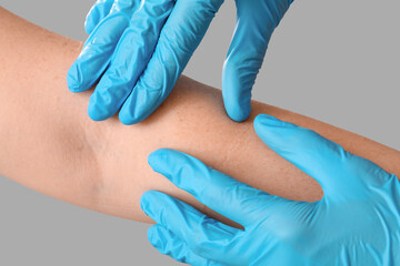 Dermatologist examining mole on woman's arm against light background, closeup