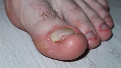 nail fungus 