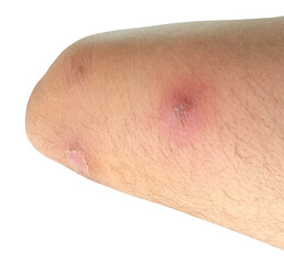 abscess or skin disease on human thigh isolated with clipping path in png file format