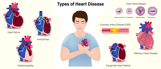 Types of heart disease vector. Heart Failure, Arrhythmias, Cardiomyopathy, Heart Valve disease, Coronary Artery Disease (CAD), Heart Inflammation and Congenital Heart Defect.