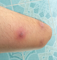 abscess or skin disease on human thigh with scars
