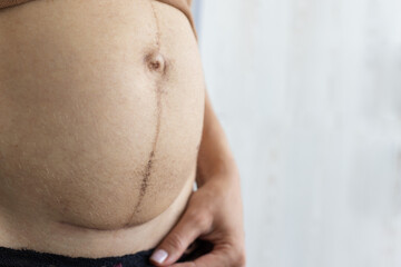 Closeup of woman belly with scar from cesarean section and dark weal after pregnancy.