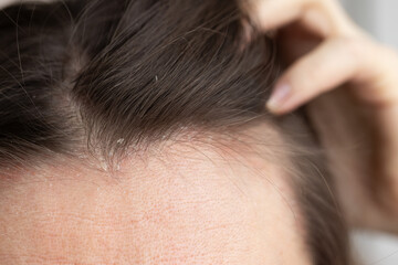 Closeup dandruff flakes on the scalp and on the hair.