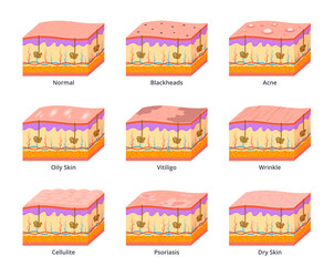 Various skin types scheme. Different skin diseases, layers section, medical infographics, epidermis with problems, blackheads, acne and vitiligo. Wrinkle and psoriasis nowaday vector set