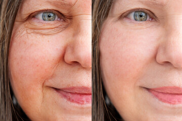 Before and after comparison eye wrinkles, smile lines mature woman, Skin texture improvement shown...