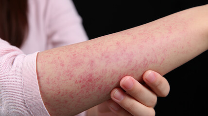 Focused arm displaying an itchy red rash emphasises skin inflammation, underscoring the importance of diagnosing allergic reactions and effective therapeutic management.

