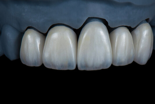 ceramic emax crowns and veneers bl4 color