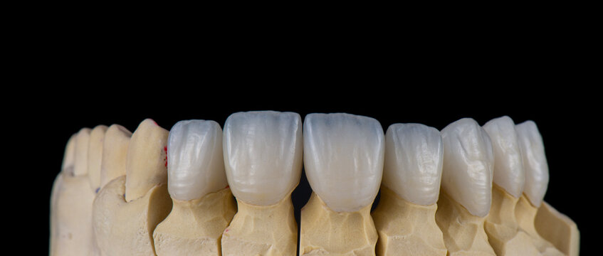 ceramic emax crowns and veneers bl4 color