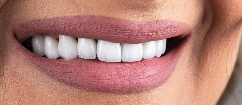 ceramic emax crowns and veneers bl4 color