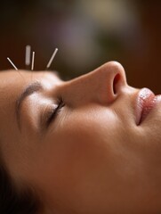 Close-up of Facial Acupuncture Session Showing Needles on Skin for Rejuvenation Therapy in Serene Environment