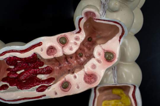 Colon Model Depicting Inflamed Diverticulitis And Mucosal Changes Pathology