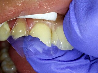 Chipped tooth getting restoration treatment still in progress 