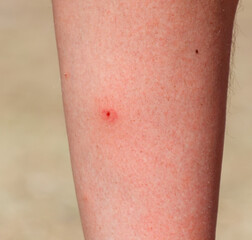A person's leg has a red mark on it