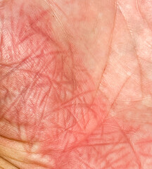 A hand with a red rash on it