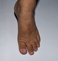 Scabies Infestation on Human Foot with Visible Skin Lesions and Irritation