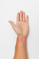 Red spots on skin of man's wrist after wearing metallic bracelet. Allergic reaction to metal