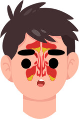 sinusitis