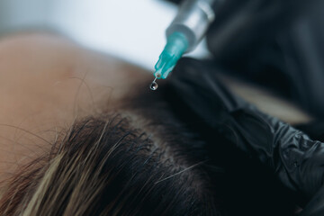 close up on woman head getting mesotherapy injections for stronger and healthier hair