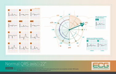 When the QRS axis is at -22&deg;, the main QRS wave is positive in lead aVL and negative in lead aVF, and the average potential is most parallel to the positive side of the aVL axis.
