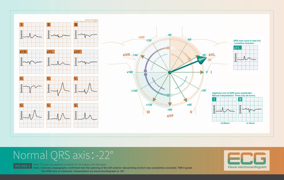 When the QRS axis is at -22&deg;, the main QRS wave is positive in lead aVL and negative in lead aVF, and the average potential is most parallel to the positive side of the aVL axis.
