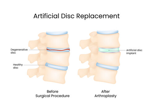 Artificial Disc Replacement Spinal Arthoplasty Illustration