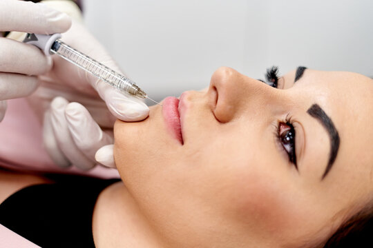 Cosmetic procedure with syringe for lip enhancement