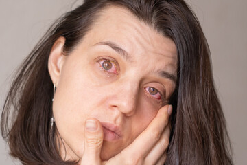 Woman showing symptoms of conjunctivitis with red eyes and discomfort in a close-up setting