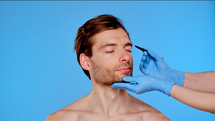 Preparation for Cosmetic Procedure with Surgical Marking Techniques