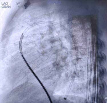 Patent ductus arteriosus (PDA) was closed by PDA closure procedure in Cath Lab.
