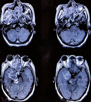 Magnetic resonance imaging (MRI) or CT scan of the brain, sinusitis, sinonasal mass, brain tumours. Metastasis.