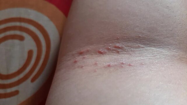 miliaria or heat rash skin rash caused by sweat