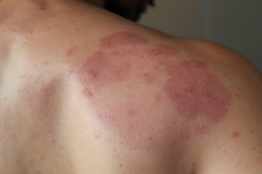 Inflamed Red Patches of Tinea Versicolor on the Shoulder and Back