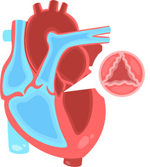 Aortic valve stenosis 