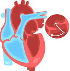 Prolapse mitral valve