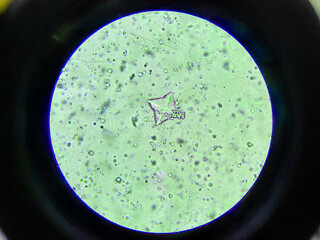 Urine Microscopy Showing Calcium Oxalate Crystals in High Magnification