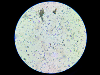 Microscopic View of Calcium Oxalate Crystals in Human Urine Sample