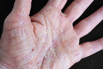 Chronic dermatitis on the hands. Hand eczema, also known as atopic dermatitis, with redness, itching, flaking and sometimes blisters or cracks on the hands