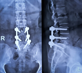 X-ray of the lumbosacral spine. Lumbar spondylosis with grade 1 spondylolisthesis of L4 over L5....