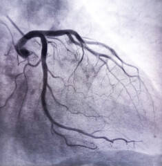 coronary angiogram of left coronary artery showed left circumflex artery (LCx) and left anterior...