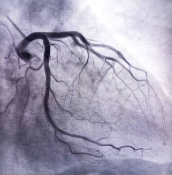 coronary angiogram of left coronary artery showed left circumflex artery (LCx) and left anterior descending artery (LAD) stenosis