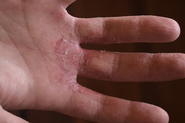 Descamação e desidratação na mão. Problema dermatológico de desidratação e coceira. Disidrose em estado crítico.