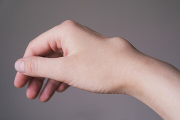 Female right back hand with ganglion cyst on the dorsum,  fluid-filled bump associated with a joint or tendon sheath, close-up view, selected focus.