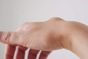 Female right back hand with ganglion cyst on the dorsum,  fluid-filled bump associated with a joint or tendon sheath, close-up view, selected focus.