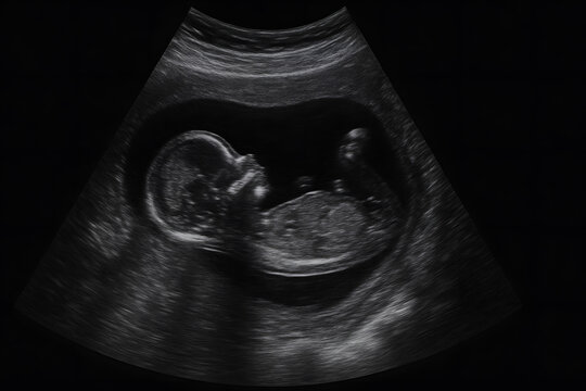 Ultrasound scan of fetus in womb, prenatal medical imaging, baby sonogram close up, pregnancy health monitoring, obstetric ultrasound, prenatal development, expectant mother checkup, fetal growth eval