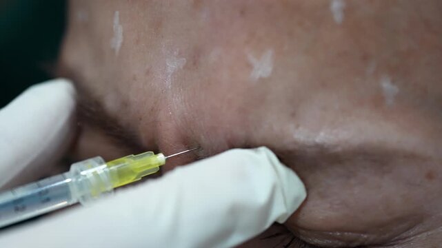 Close up of woman receiving anti-wrinkle injection between, Cosmetic procedure, injection into the glabella of a female patient for anti-aging.