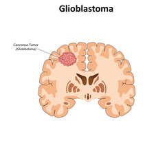 Glioblastoma vector illustration
