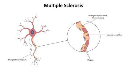 Obraz premium Multiple sclerosis vector illustration