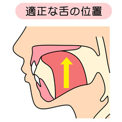 正しいミューイングの方法　適正な舌の位置と誤った舌の位置 © koti