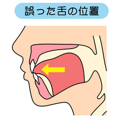 正しいミューイングの方法　適正な舌の位置と誤った舌の位置 © koti