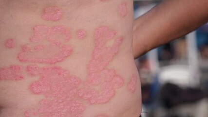 A participant shares their skin condition experience at a community health event focused on dermatology awareness and treatment.